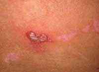 Genital Herpes - buttox