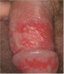 Cold Herpes Photo Sore